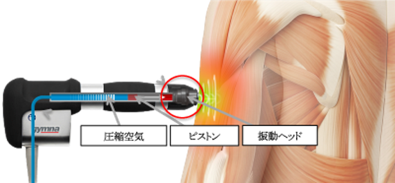 痙縮治療の新たな選択肢 「体外衝撃波（ショックウェーブ）治療器」を 